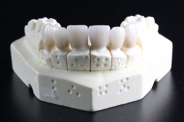 tooth-replacement-759929_1280